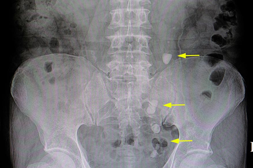 Stummer Nierenstein Wie Viel Therapie Ist N Tig