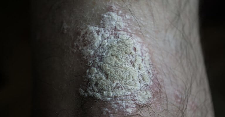 Can Psoriasis Come And Go Quickly