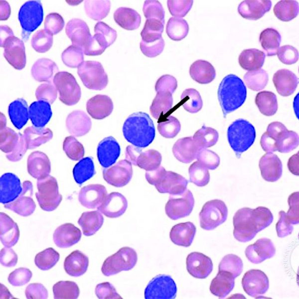 DFP Literaturstudium: Chronisch lymphatische Leukämie | medonline