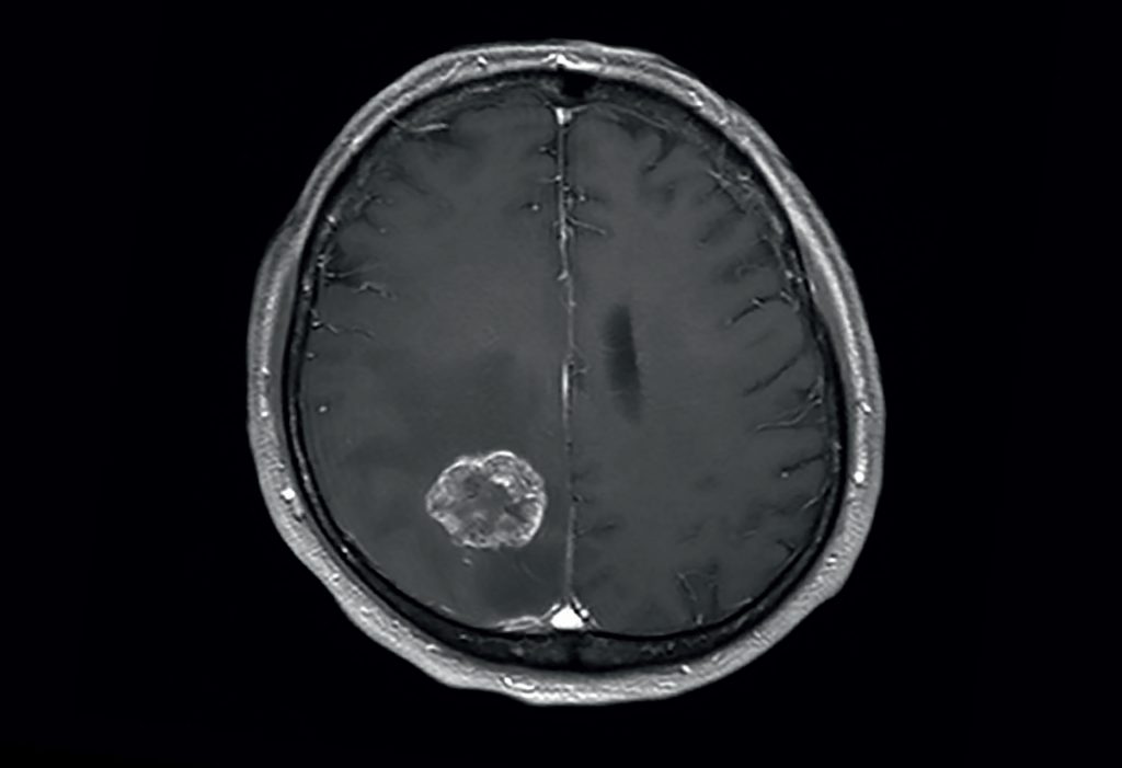 Neurochirurgie von Gehirnmetastasen