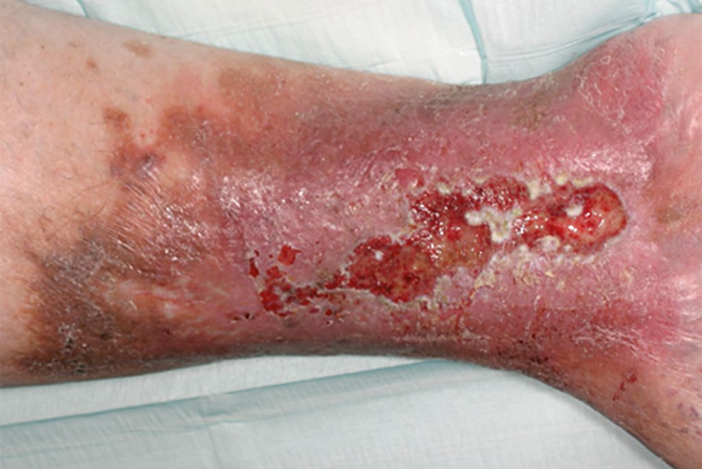 Foto: Dissemond/Hautklinik Essen