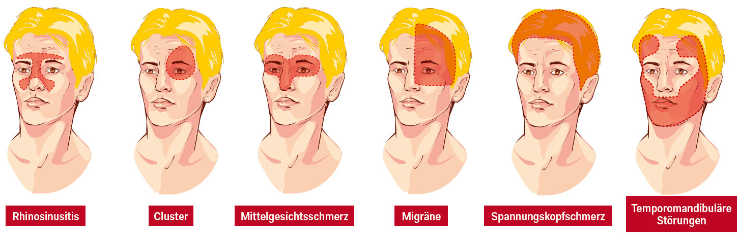 Stirn schmerzen nebenhöhlen Infektionen: Entzündungen