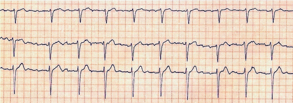 FOTO: ECGPEDIA.ORG/W.G. DE VOOGT, MD, PHD, SLAZ, THE NETHERLANDS