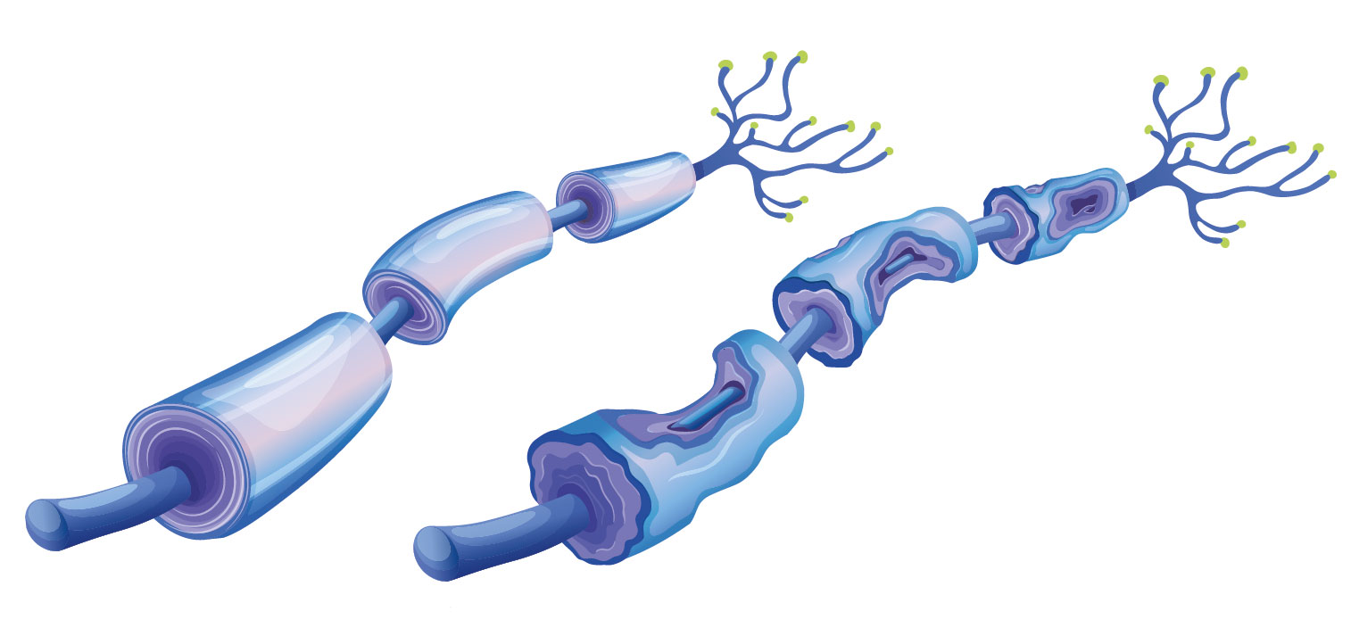 und immunmediierte Neuropathien