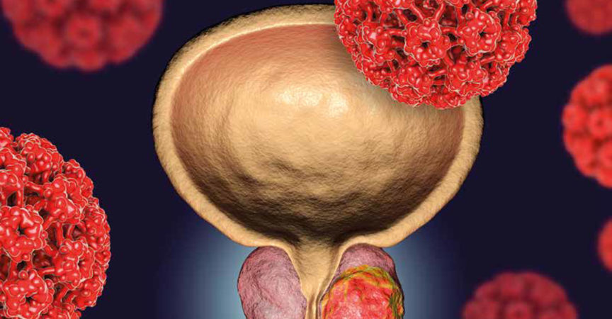 Biomarker Als Wegweiser Zur Prostata Ca Therapie Medonline