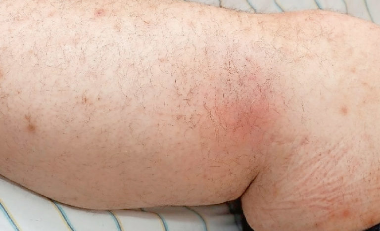 Fallbericht Allergische Reaktion auf Tattoofarben Pharmaceutical Tribune