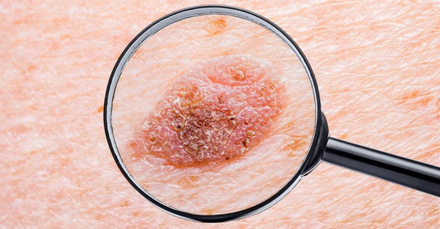 Hautmole-Defekt-Makrofoto mit hoher Vergrößerung für die medizinische Diagnose