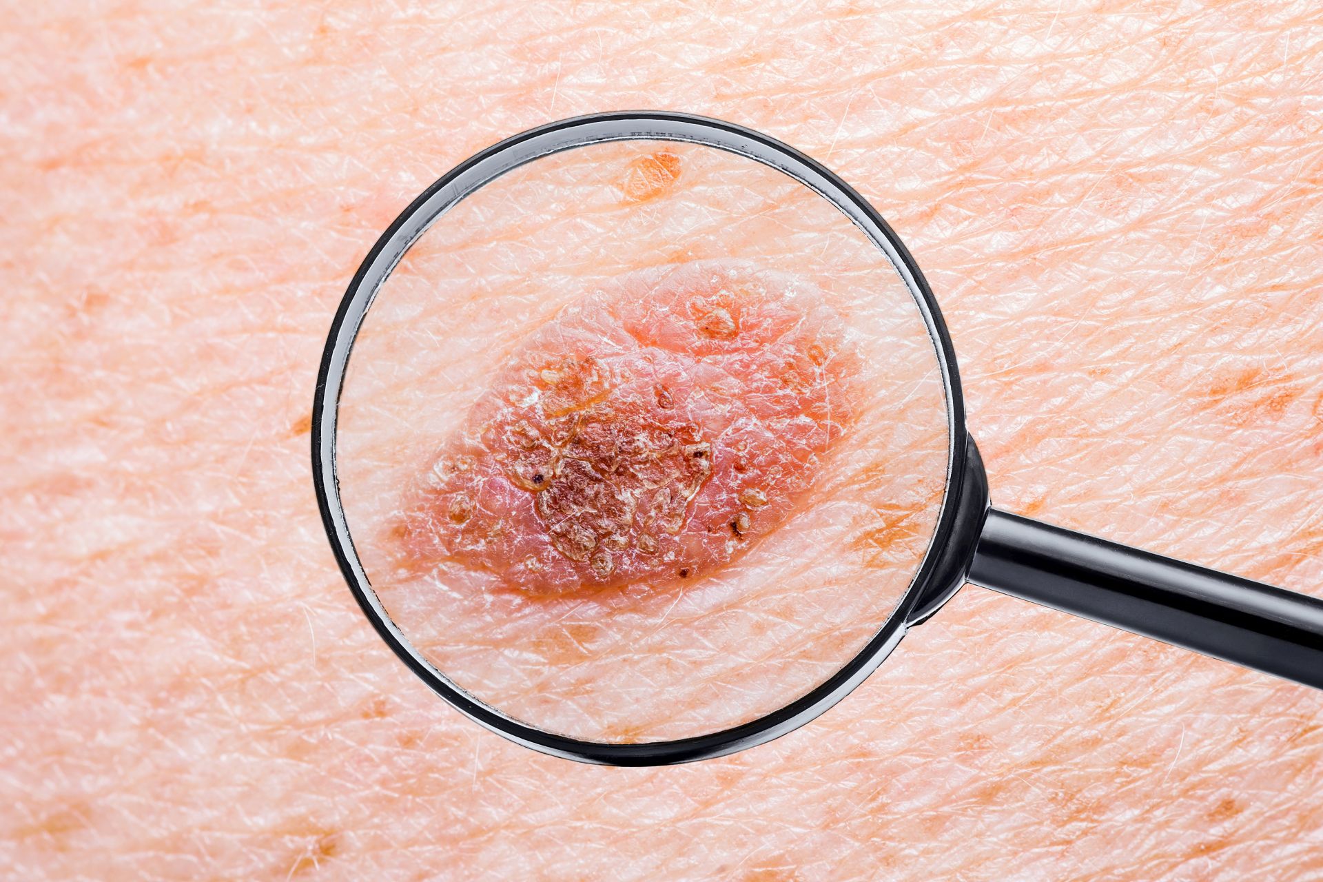 ASCO 2019: 17 Highlights zum Melanom