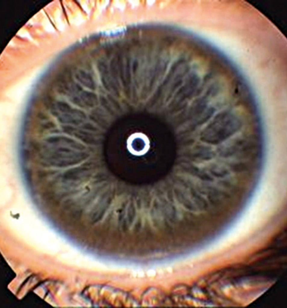 Morbus Wilson Symptome, Diagnose, Therapie