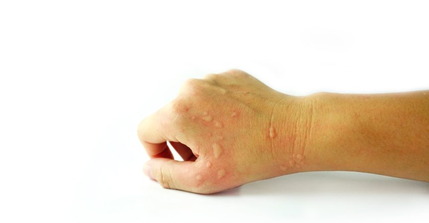 Dermatitis Problem von Hautausschlag, Allergie Hautausschlag und Gesundheitsproblem auf Arm weißen Hintergrund