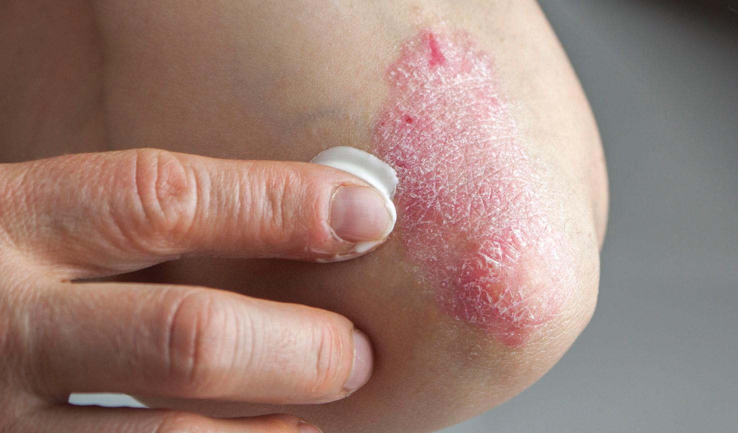 psoriasis-die-richtige-pflege