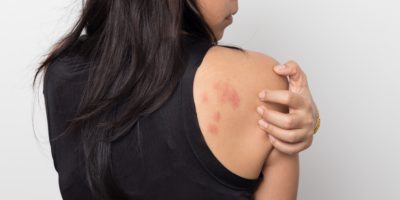 Frau zeigt ihre Haut hinterher juckend, mit Allergie Hautausschlag Urtikaria Symptome