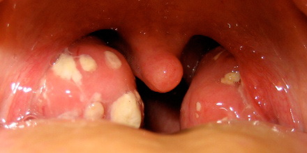 Bei Akuter Tonsillitis Bleibt Penicillin Erste Wahl Medical