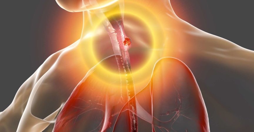 Speiseröhrenkrebs, 3D-Darstellung zeigt bösartigen Tumor in der menschlichen Speiseröhre