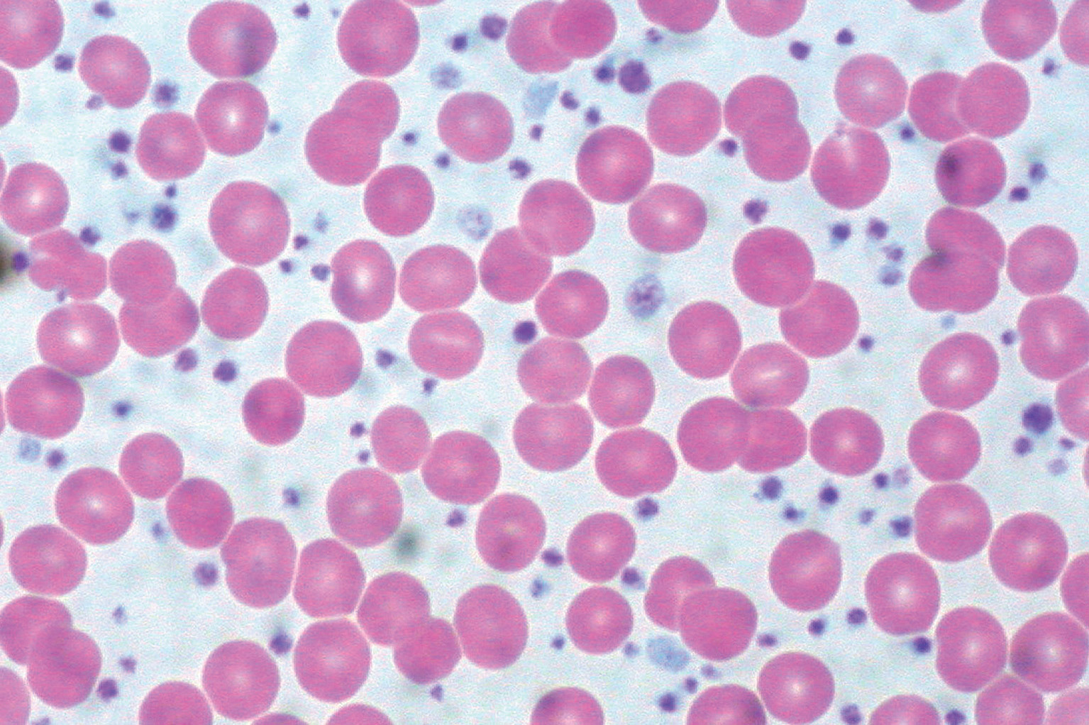 Thrombozytosen mit drei einfachen Tests abklären