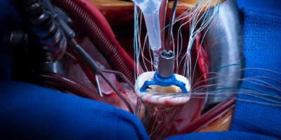 Mitralklappe bei Mitralinsuffizienz