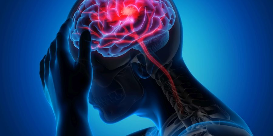 Medizinische Darstellung eines Gehirns mit Schlaganfallsymptomen
