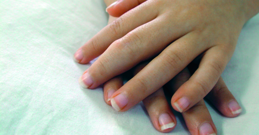 Fünfjähriges kleines Mädchen mit J.R.A. (Jeuvanile rheumatoide Arthritis)