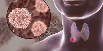 Schilddrüsenkrebs. 3D-Illustration, die Schilddrüse mit Tumor innerhalb des menschlichen Körpers und Nahaufnahme von Schilddrüsenkrebszellen zeigt
