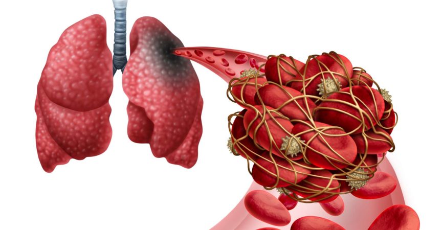 Lungenembolie mit einem Blutgerinnsel als Krankheit mit einer Verstopfung einer Arterie in der Lunge mit 3D-Illustrationselementen.