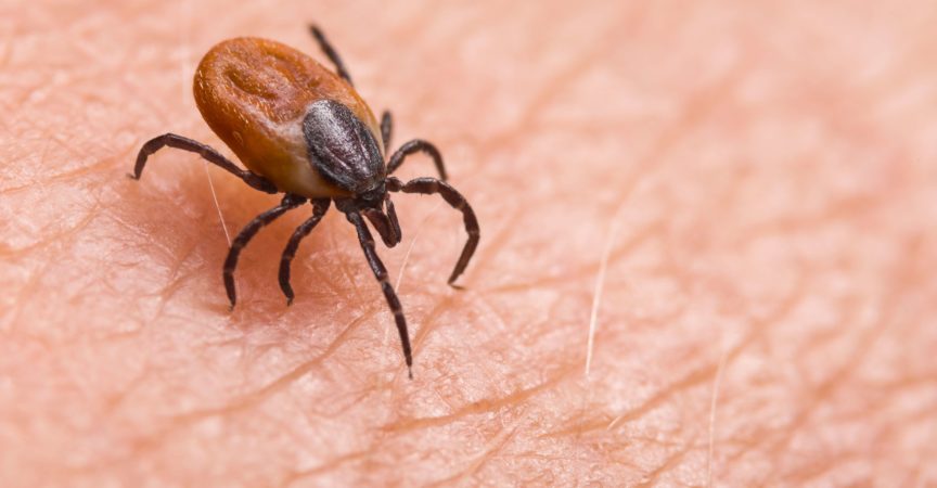 Infizierte weibliche Hirsche ticken auf haariger menschlicher Haut. Ixodes ricinus. Gefährliches Milbendetail. Acarus. Infektiöse Borreliose