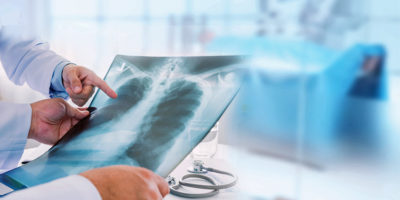 Röntgenbild von der Lunge
