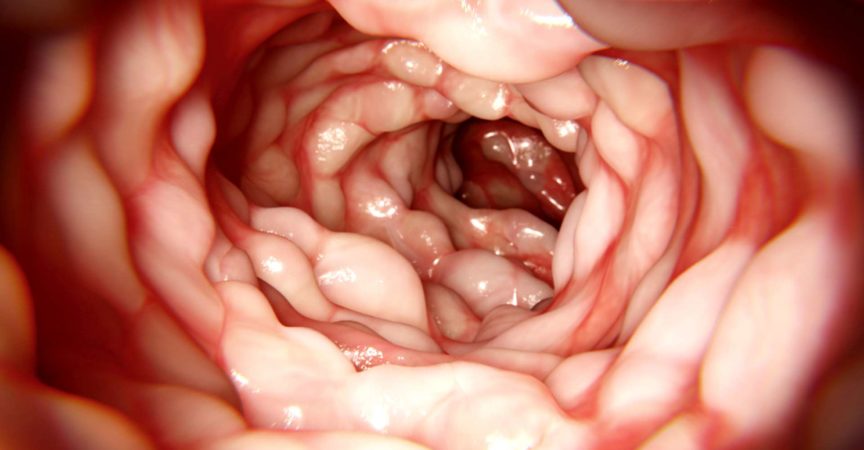 Morbus Crohn ist eine entzündliche Darmerkrankung, die Bauchschmerzen, Durchfall und Erbrechen verursacht.