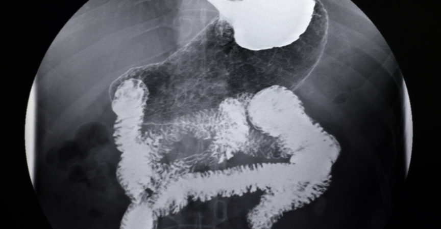 Röntgen-Magen-Darm-Angiographie-Bild des menschlichen Magens,