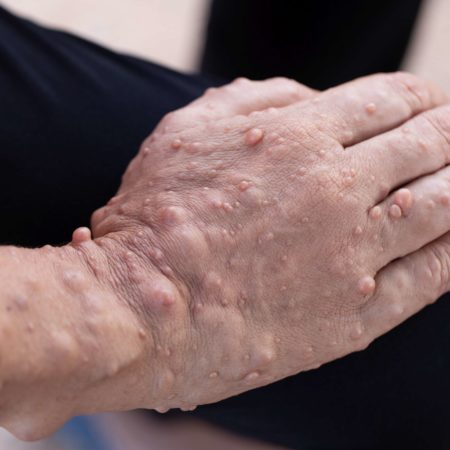 Neurofibromatose (NF) ist eine Erkrankung, bei der Tumore wachsen. Zu den Symptomen gehören hellbraune Flecken auf der Haut.