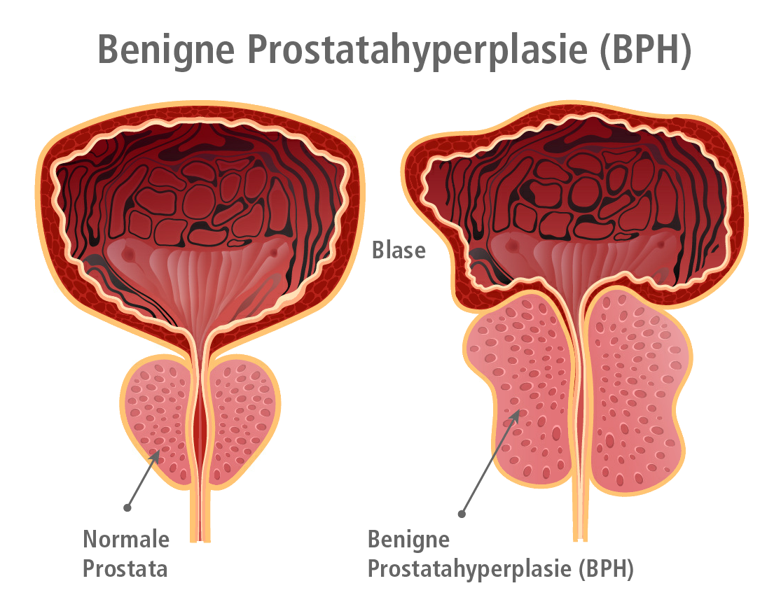 benigne prostatahyperplasie( bph) prostata aumentada psa alto