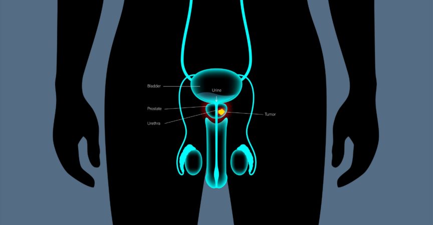 Prostatakrebs-Konzept