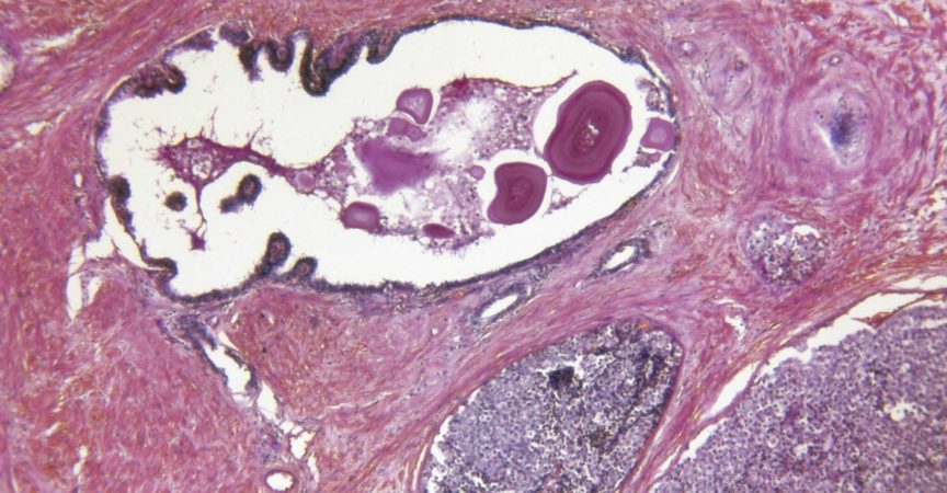 Prostata Adenocarcinoma