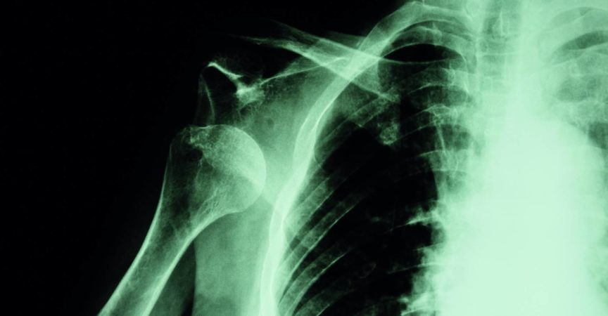 Röntgen der vorderen Schulterluxation