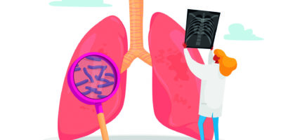 Lungenspezialist, professioneller Arzt Charakter mit Röntgenbild der Lunge Lernende Patientenfluorographie mit Tuberkulose oder Lungenentzündung, Arbeit des medizinischen Personals. Karikatur-Vektor-Illustration