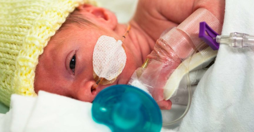 Baby 33 Wochen und 5 Tage alt mit einer Ernährungssonde durch Nase und Augen offen.