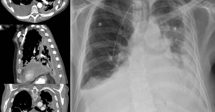 Fortgeschrittenes Mesotheliom aufgrund von Asbestexposition bei CT und Röntgen