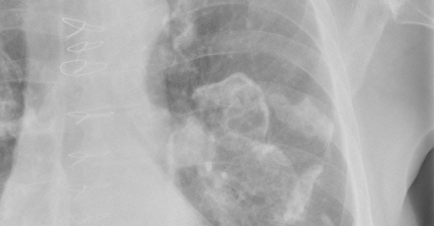Nahaufnahme von verkalkten Pleuraasbestplaques auf dem Röntgenbild der Brust