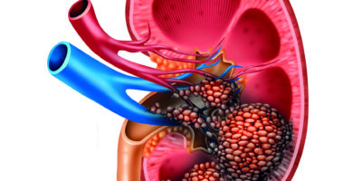Anatomie des menschlichen Nierenkrebses