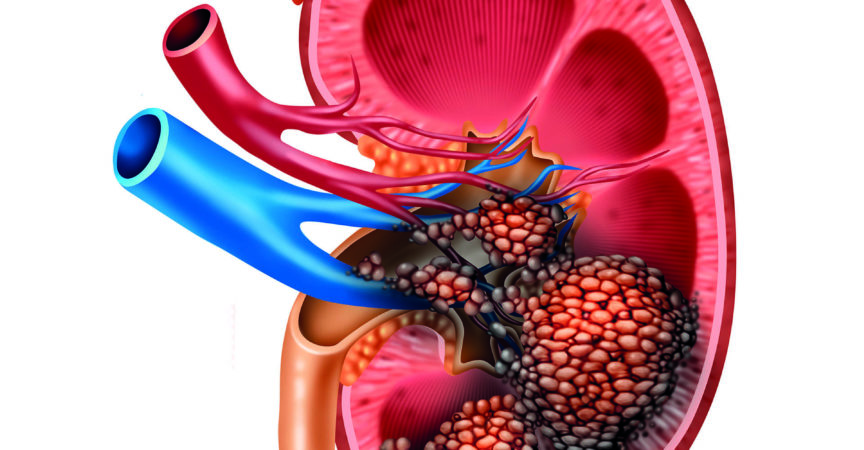 Anatomie des menschlichen Nierenkrebses