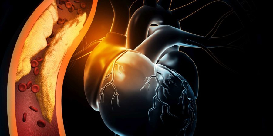Menschliches Herz mit verstopften Arterien. 3D-Illustration
