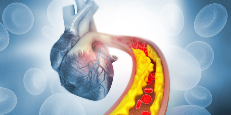Cholesterin-Plaque in der Arterie mit Anatomie des menschlichen Herzens. 3D-Darstellung