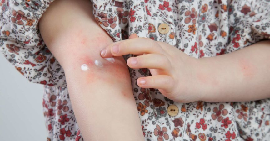 Kleinkindmädchen, das an atopischer Dermatitis leidet, Nahaufnahmebild. Rote und juckende Haut. Ekzem am Arm des Kindes.