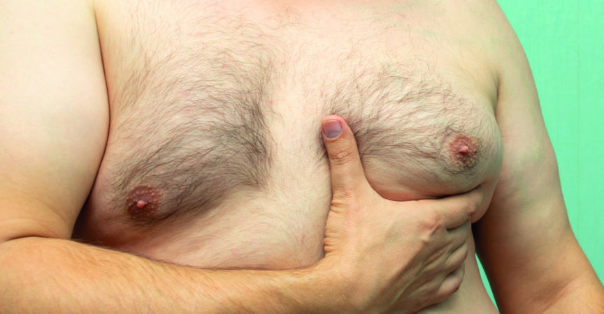dicker weißer Mann mittleren Alters mit Gynäkomastie, vergrößerter Brust