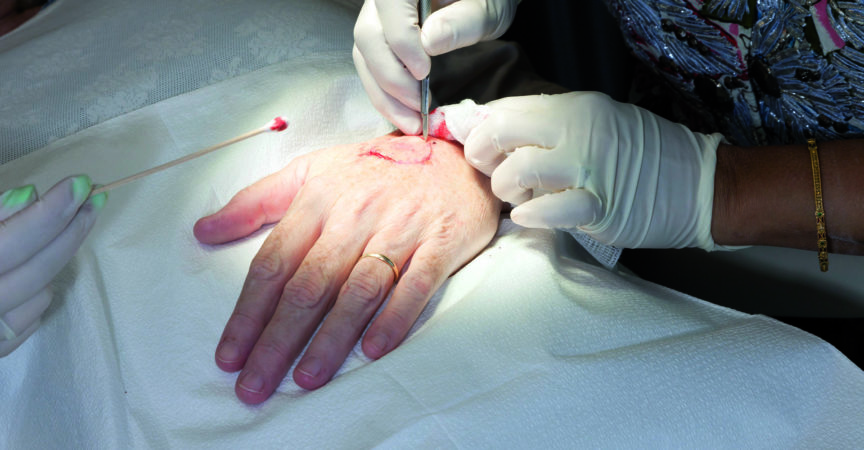 Einen chirurgischen Schnitt machen – Operationstechnik nach Mohs
