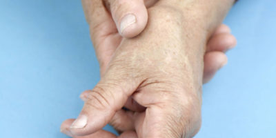 Hände einer Frau, die an rheumatoider Arthritis verformt ist