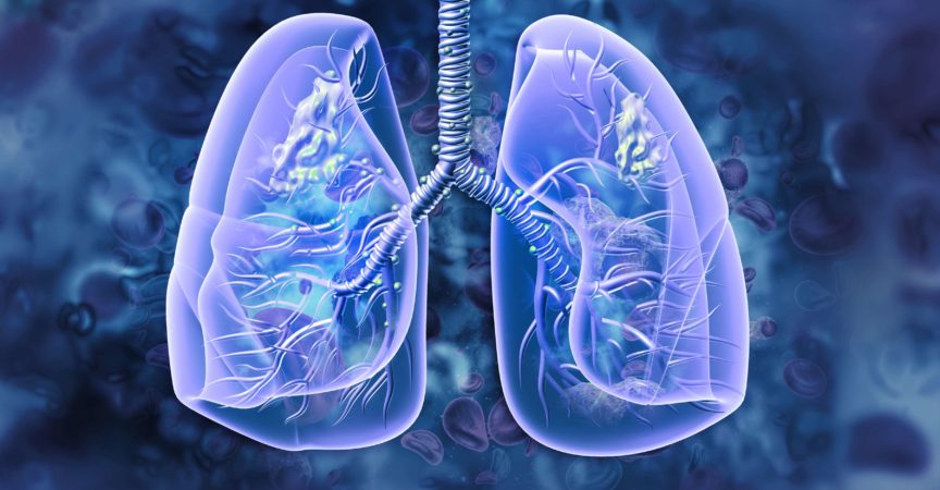 Lungenkrebs. Lungenerkrankung. 3D-Darstellung