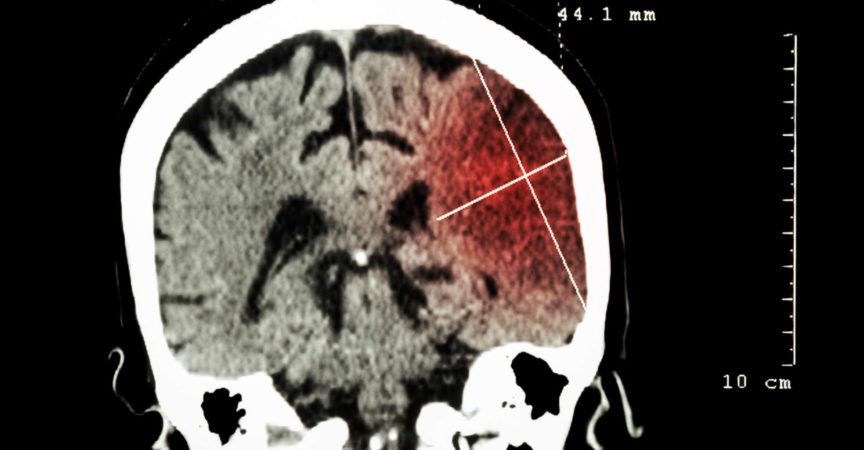 Hirninfarkt in der linken Hemisphäre (ischämischer Schlaganfall) (CT-Scan des Gehirns): Hintergrund in Medizin und Wissenschaft