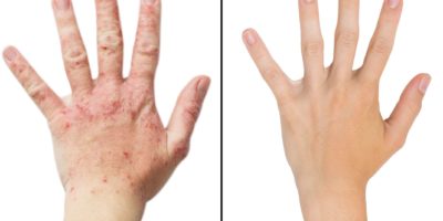 Echte Fotomädchenhand, der Patient mit Ekzemen vor und nach der Behandlung. Isolierter weißer Hintergrund