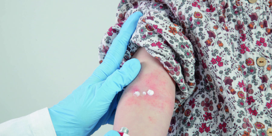 Arzt trägt Salbe auf rotes und juckendes Ekzem am Arm des Kindes auf. Kleinkindmädchen, das an atopischer Dermatitis leidet, Nahaufnahme Bild.