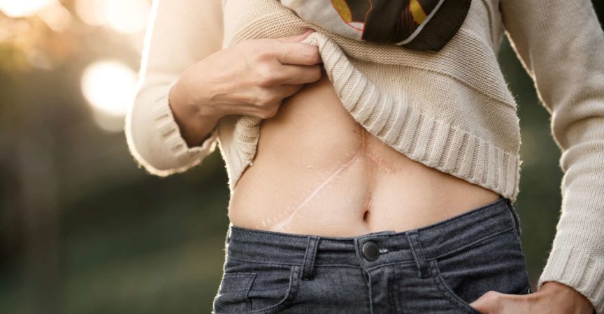 Nahaufnahme des Bauches eines Mädchens mit Lebertransplantationsnarben.